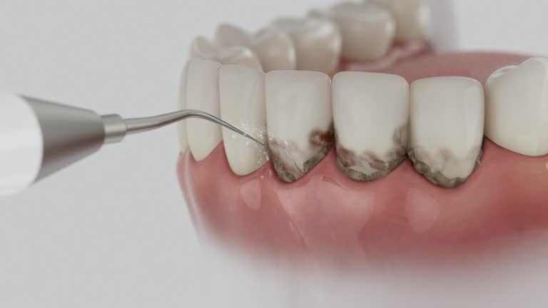 Trusted Dental Implants service in Kitsap Lake, WA - Dentist Open Now